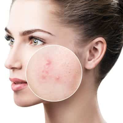 Kosmetische Behandlungen / Frauengesicht mit einer unreinen Haut
