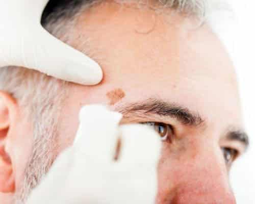 Kosmetische Behandlungen / Mann mit Altersfleck im Gesicht 
